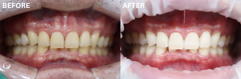 teeth whitening korea cost