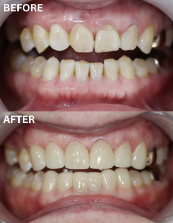 teeth whitening korea price
